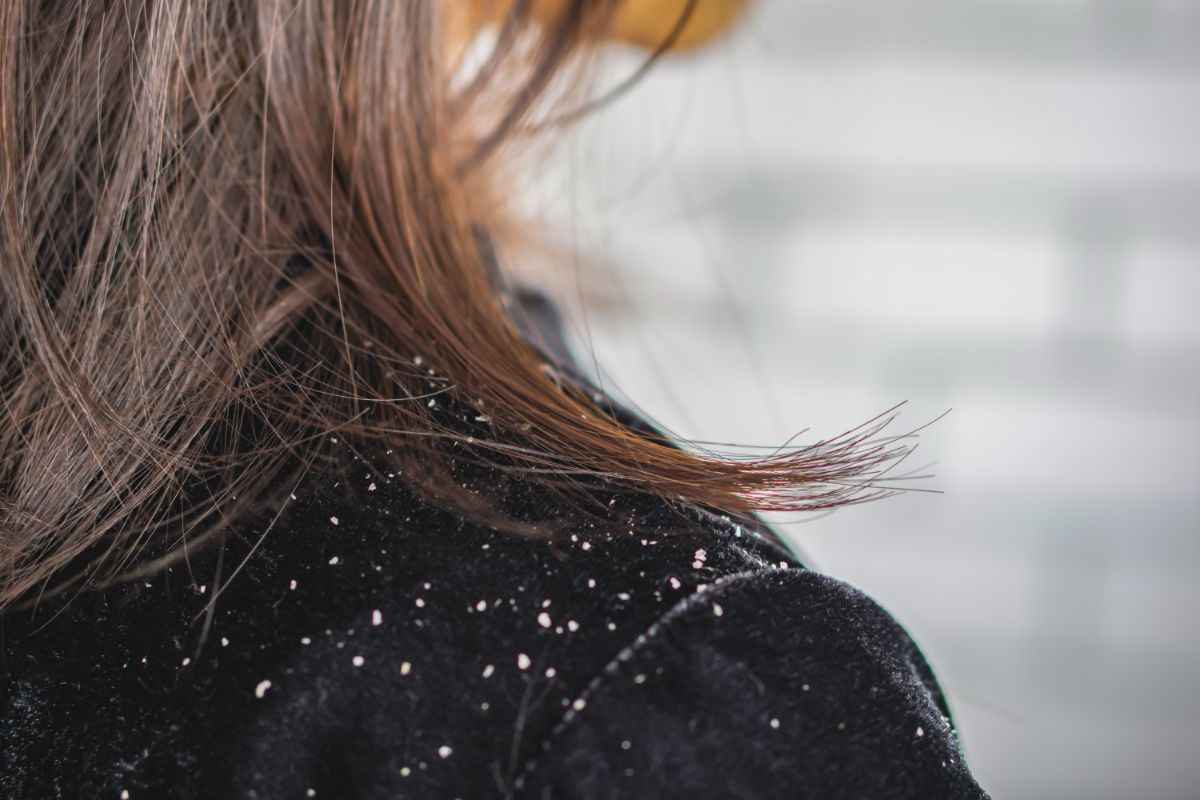 abiti forfora capelli