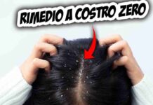 capelli forfora disagio